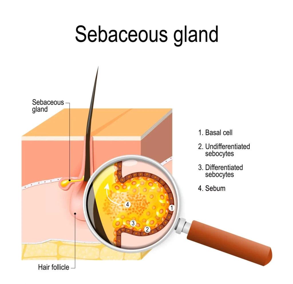 Can You Get Rid of Sebaceous Filaments Permanently