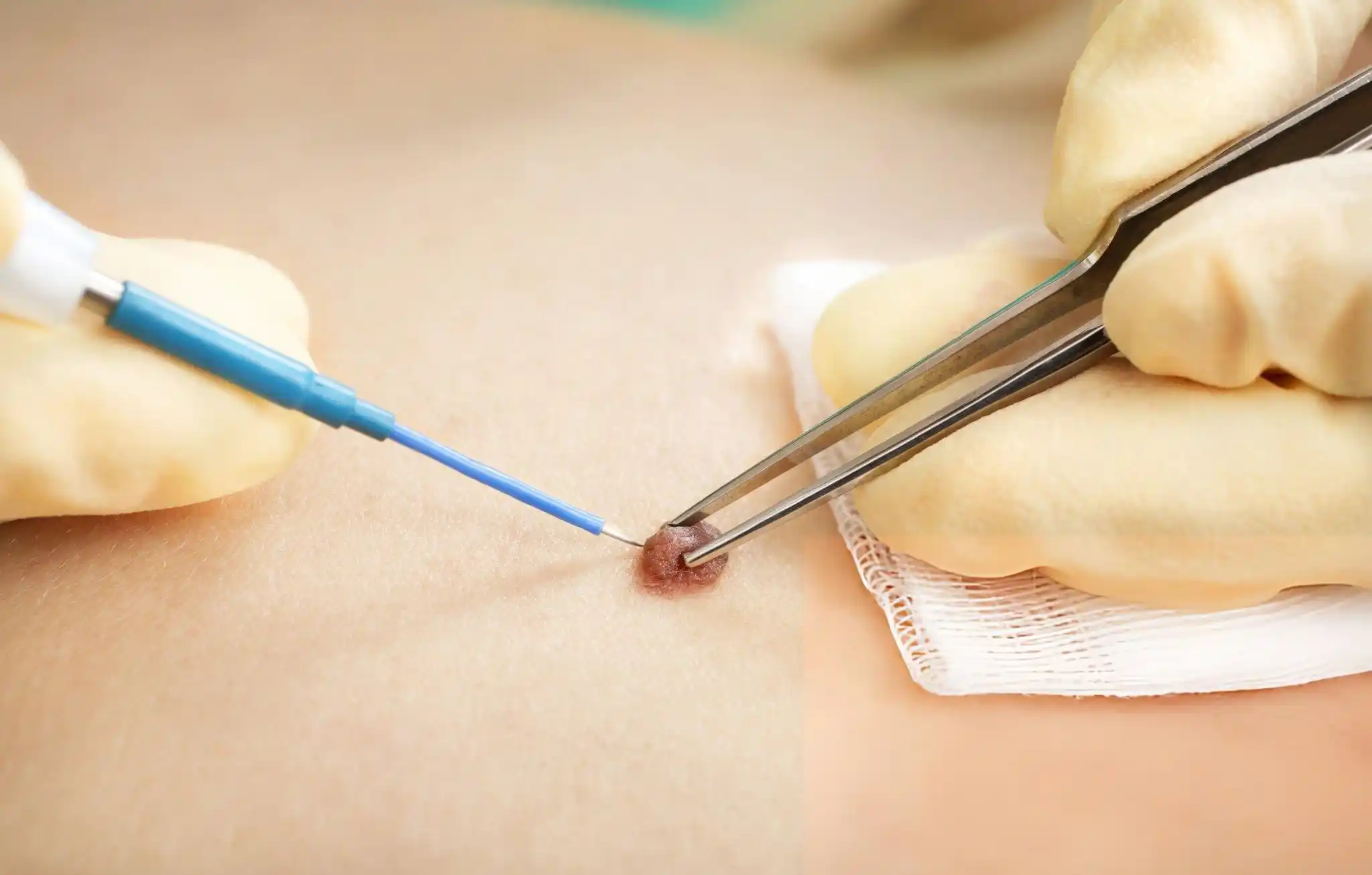 Cherry Angioma Removal Cherry Angioma Removal