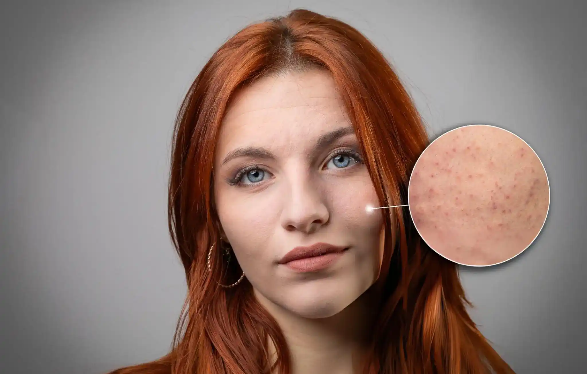 Keratosis Pilaris