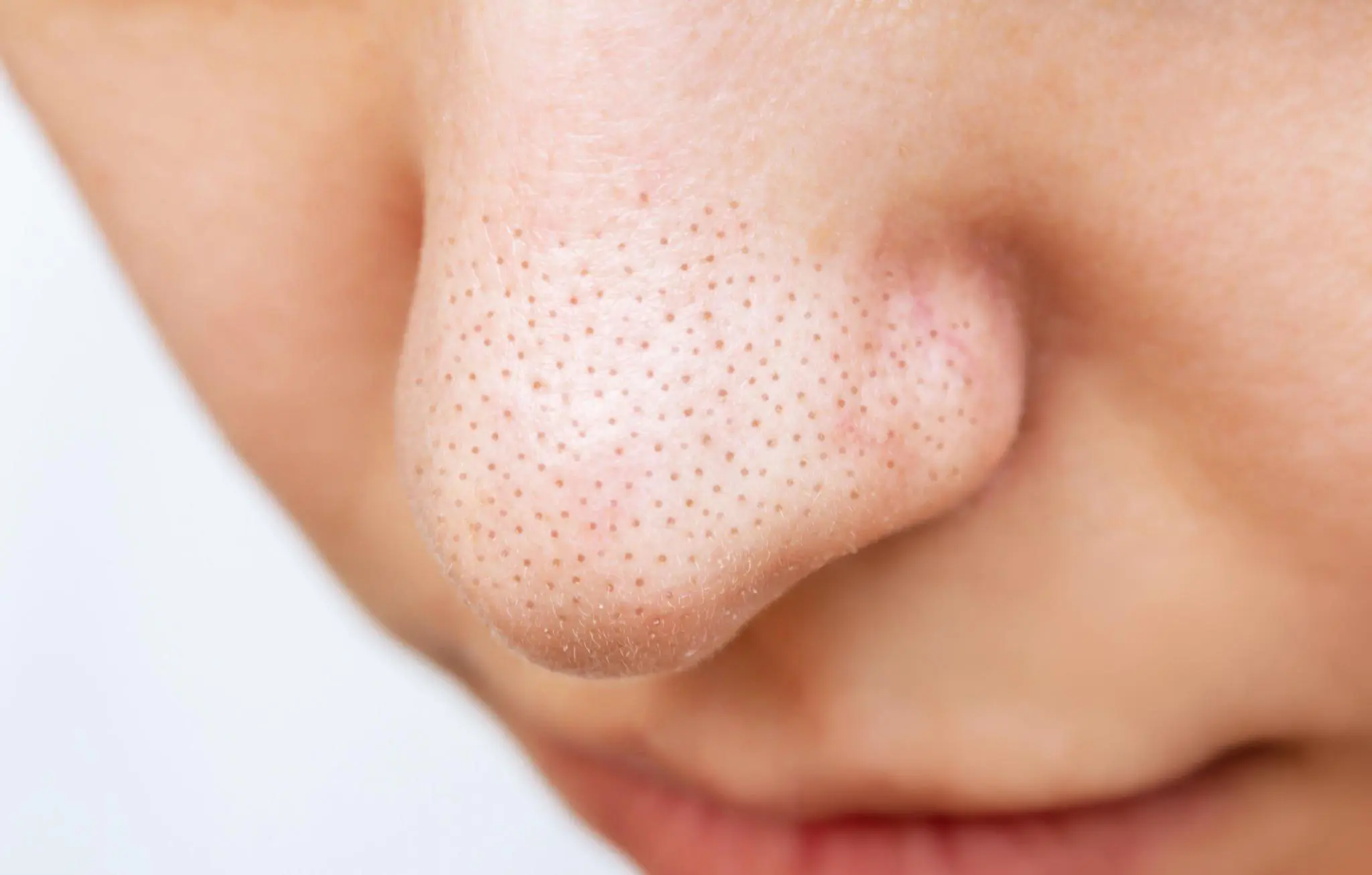 What Are Blackheads