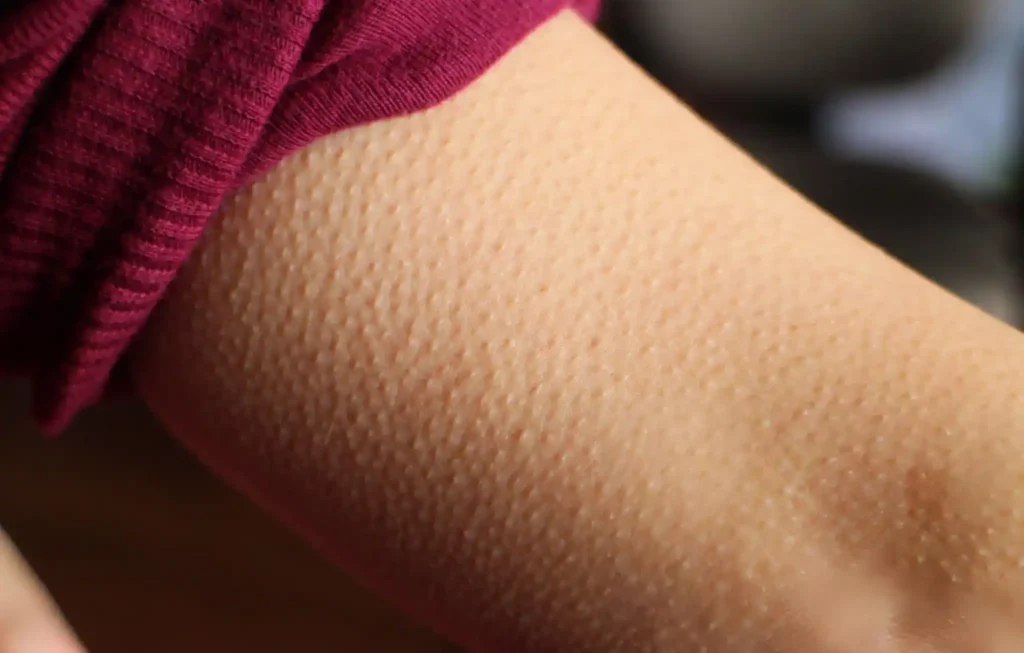 What Causes Keratosis Pilaris