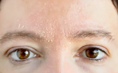 Why Is My Skin Flaking Why Is My Skin Flaking? Common Causes and What Helps