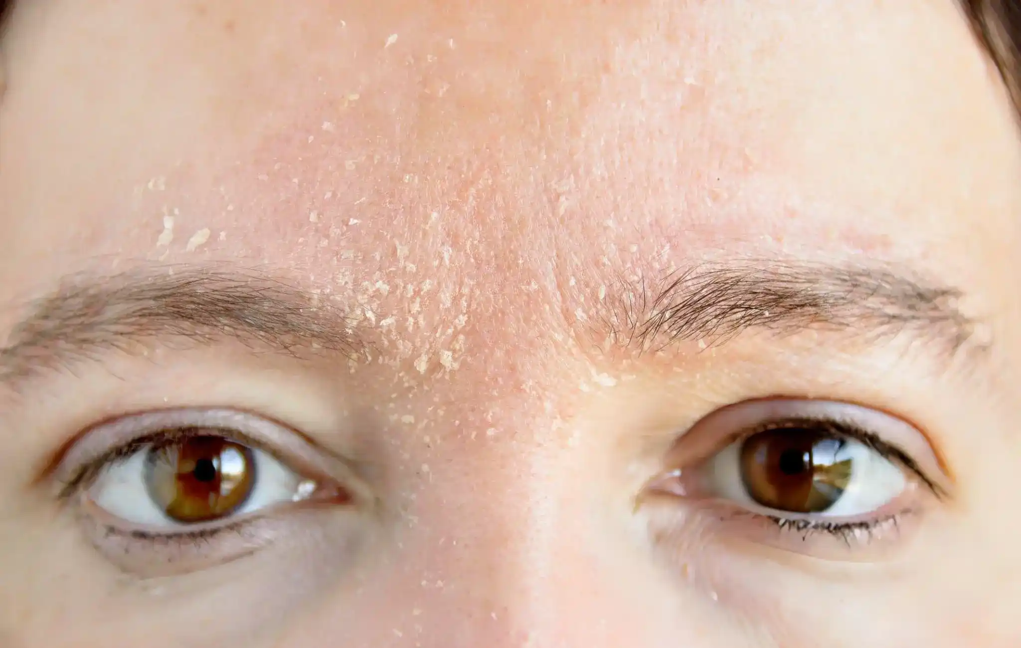 Why Is My Skin Flaking Why Is My Skin Flaking