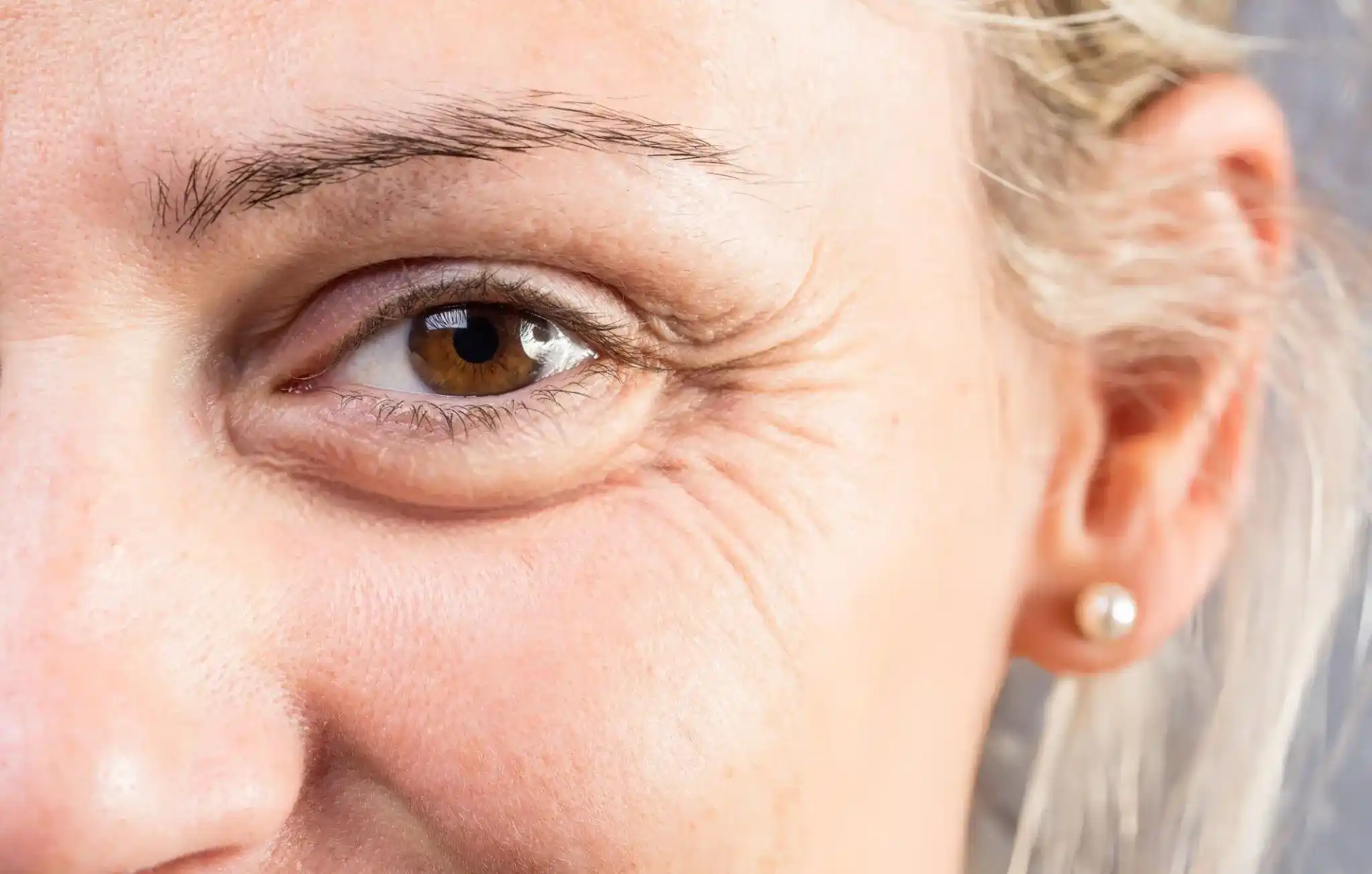 Crepey Skin Under Eyes
