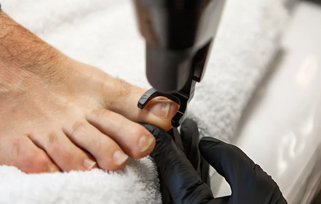 Fungal Nail Infection Fungal Nail Infection