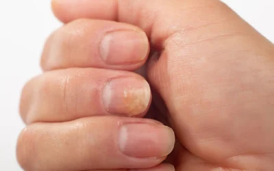 Fungal Nail Infection Treatment Fungal Nail Infection Treatment