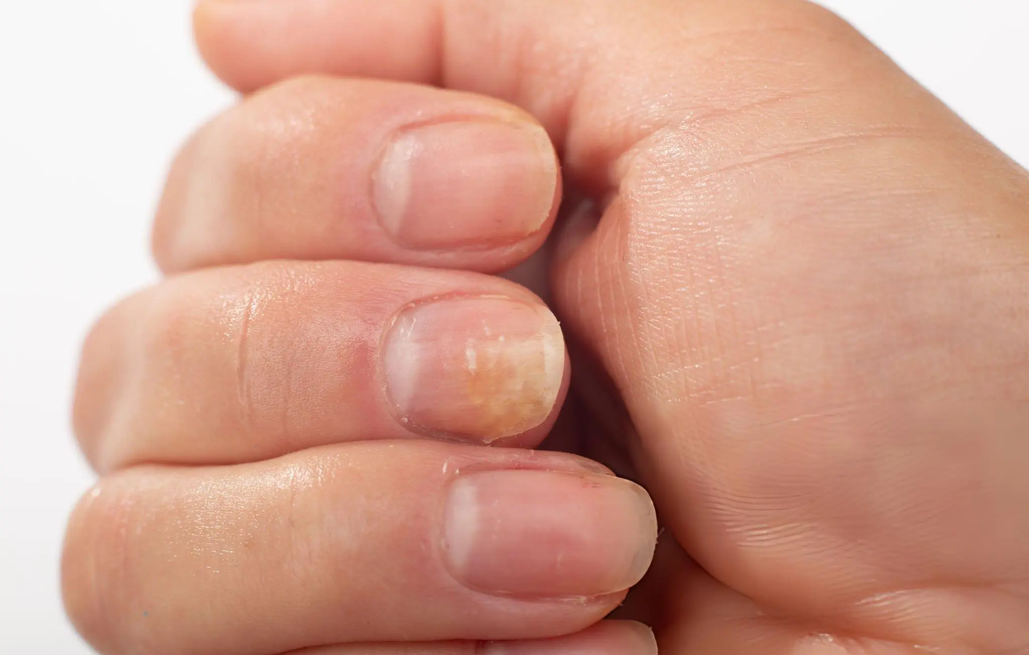 Fungal Nail Infection Treatment Fungal Nail Infection Treatment