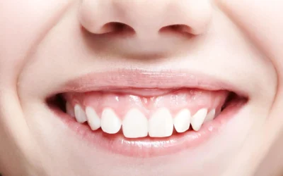 Gummy Smile What Causes a Gummy Smile? Treatment Options Explained