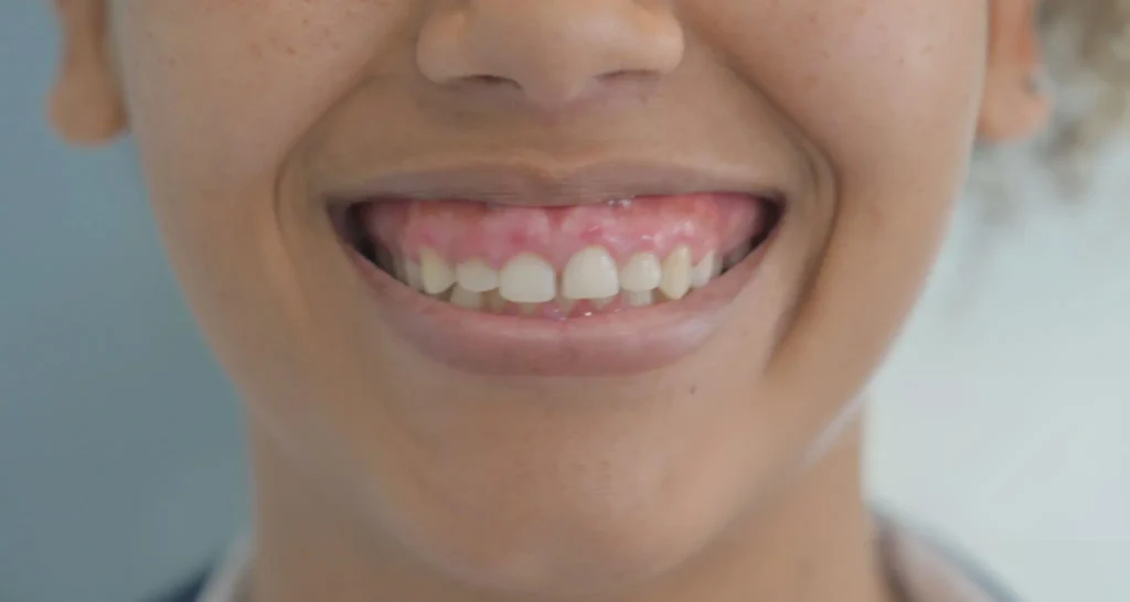 Gummy Smile Treatment Gummy Smile Treatment