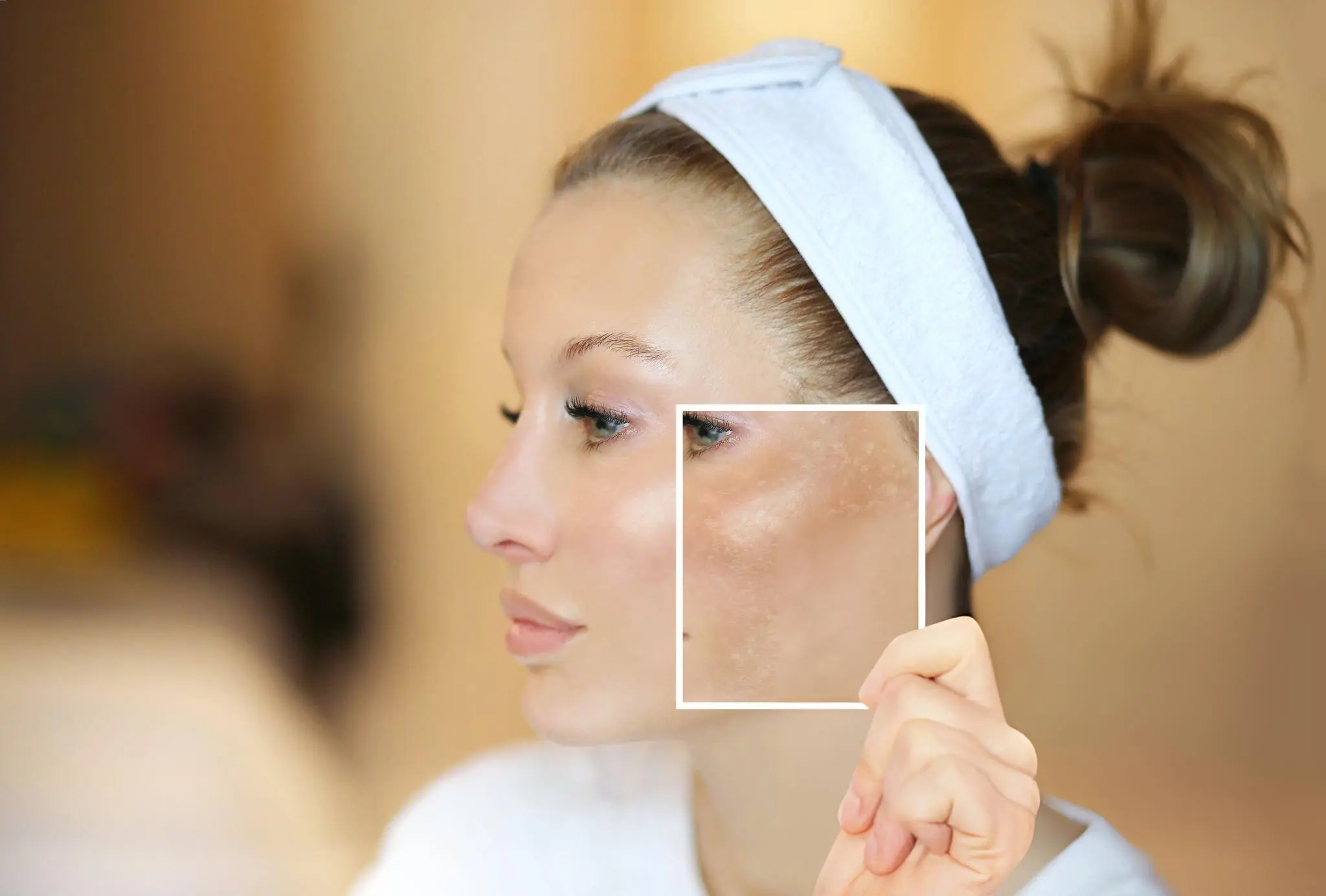 Post-Inflammatory Hyperpigmentation Post-Inflammatory Hyperpigmentation