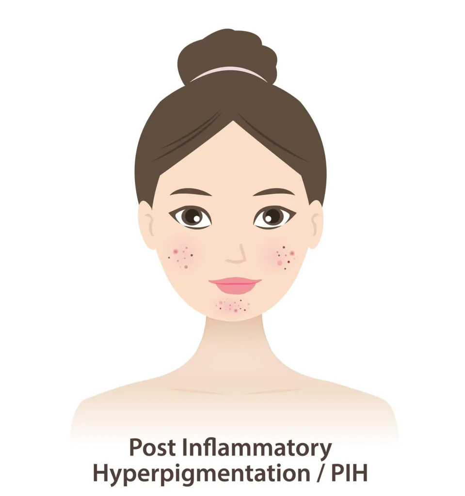 Professional Treatments That May Support PIH Professional Treatments That May Support PIH
