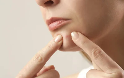 Skin Purging vs Breakout – Key Differences You Should Know
