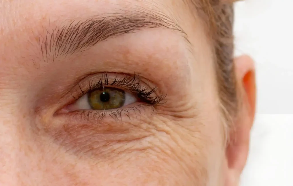 What Causes Crepey Skin Under the Eyes