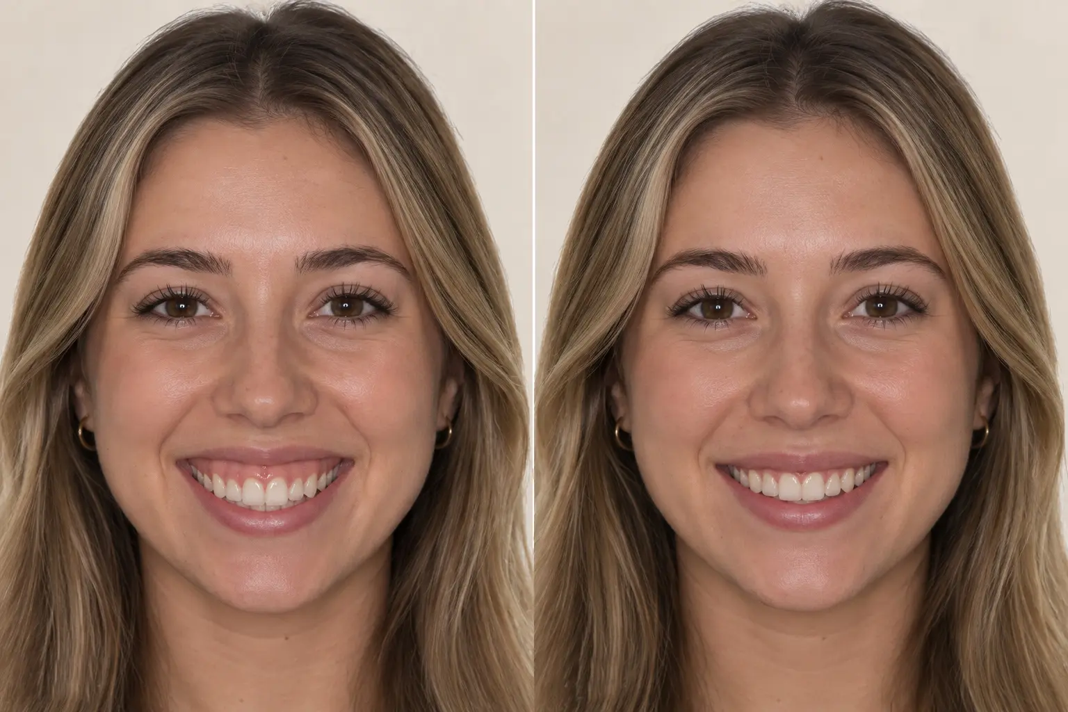 What Is Lip Enhancement