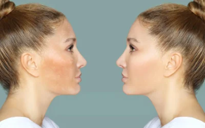 Melasma vs Hyperpigmentation – Understanding the Key Differences