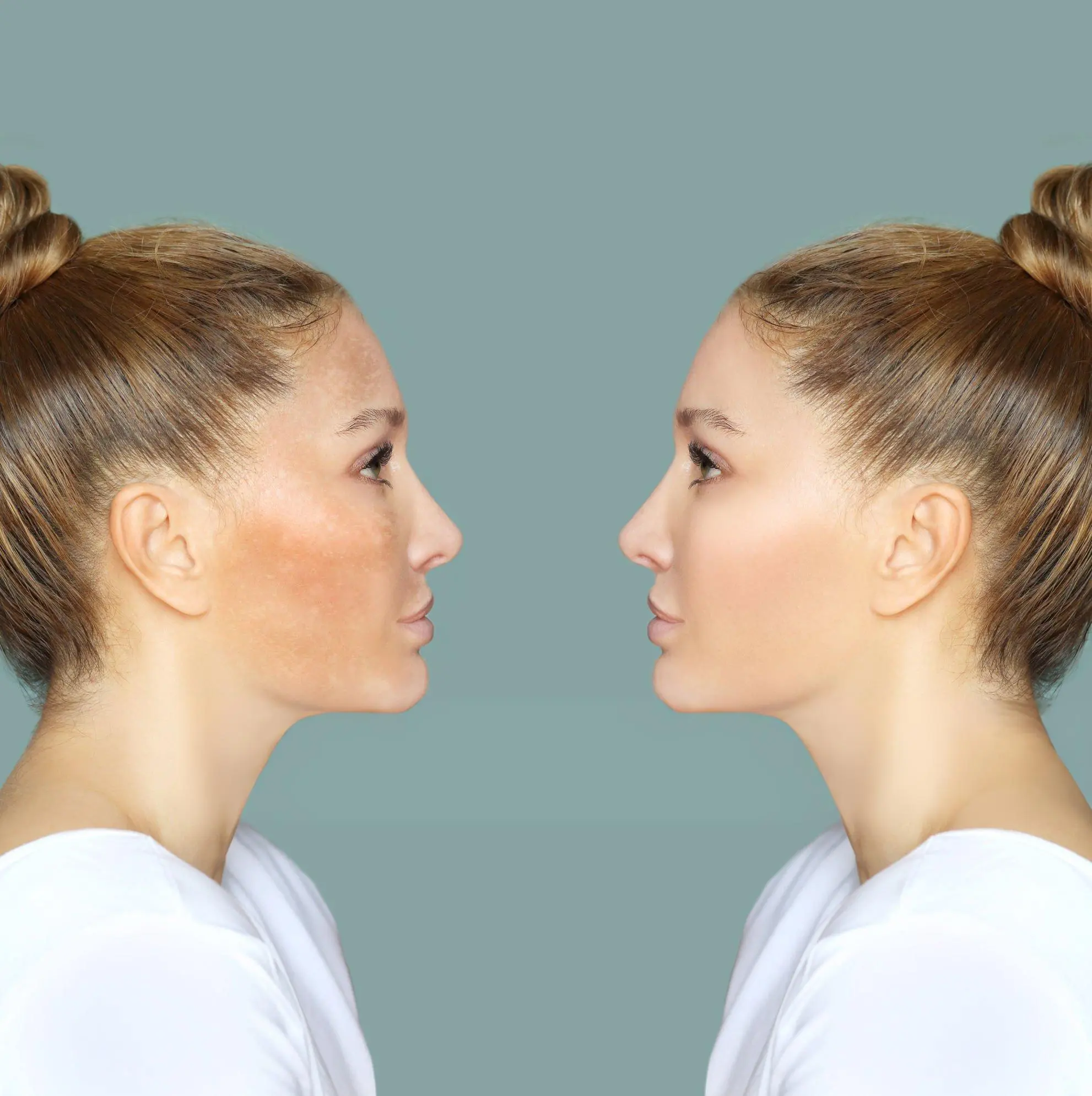 Melasma vs Hyperpigmentation