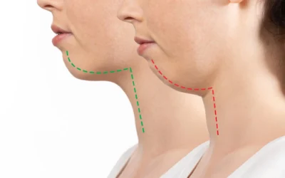 Sagging Jawline Jowls Sagging Jawline & Jowls – Non-Surgical Skin Tightening Options in Newcastle