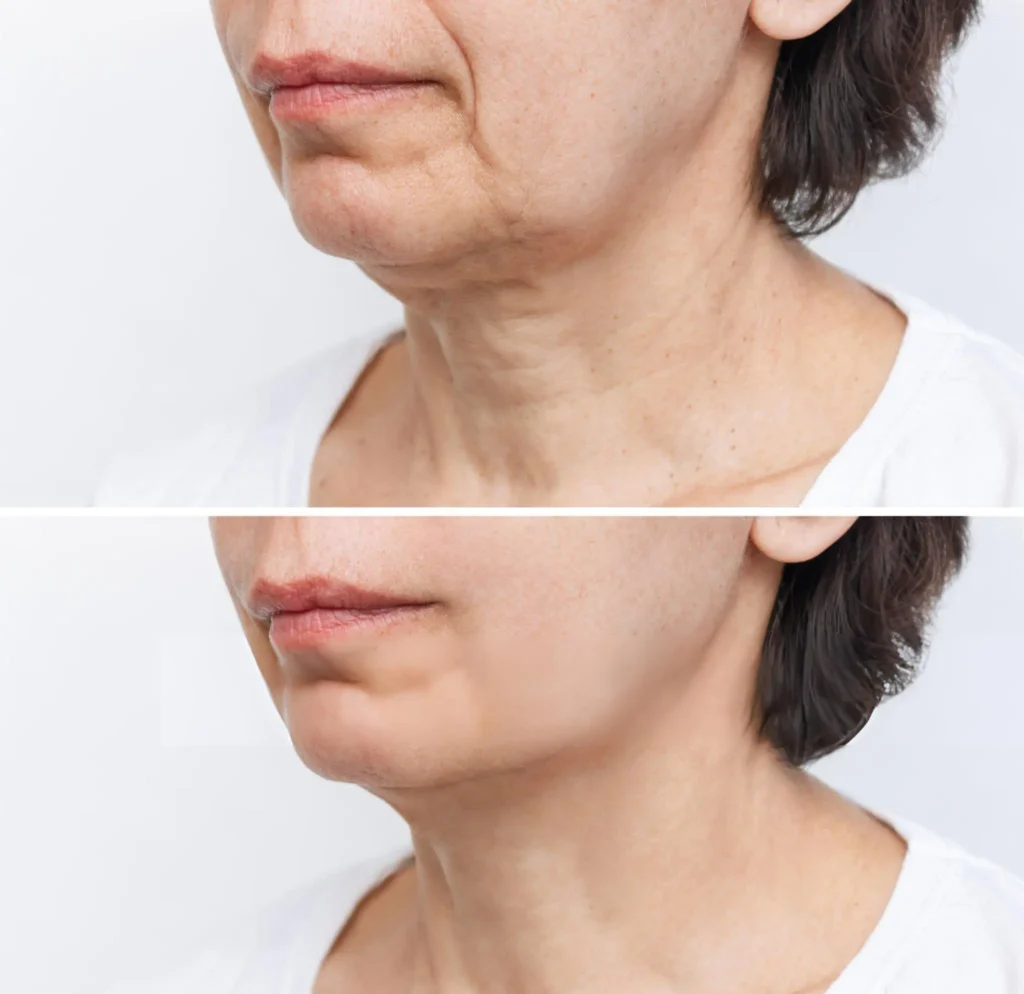 Sagging Jawline Jowls treatment in nsw Sagging Jawline & Jowls treatment in nsw
