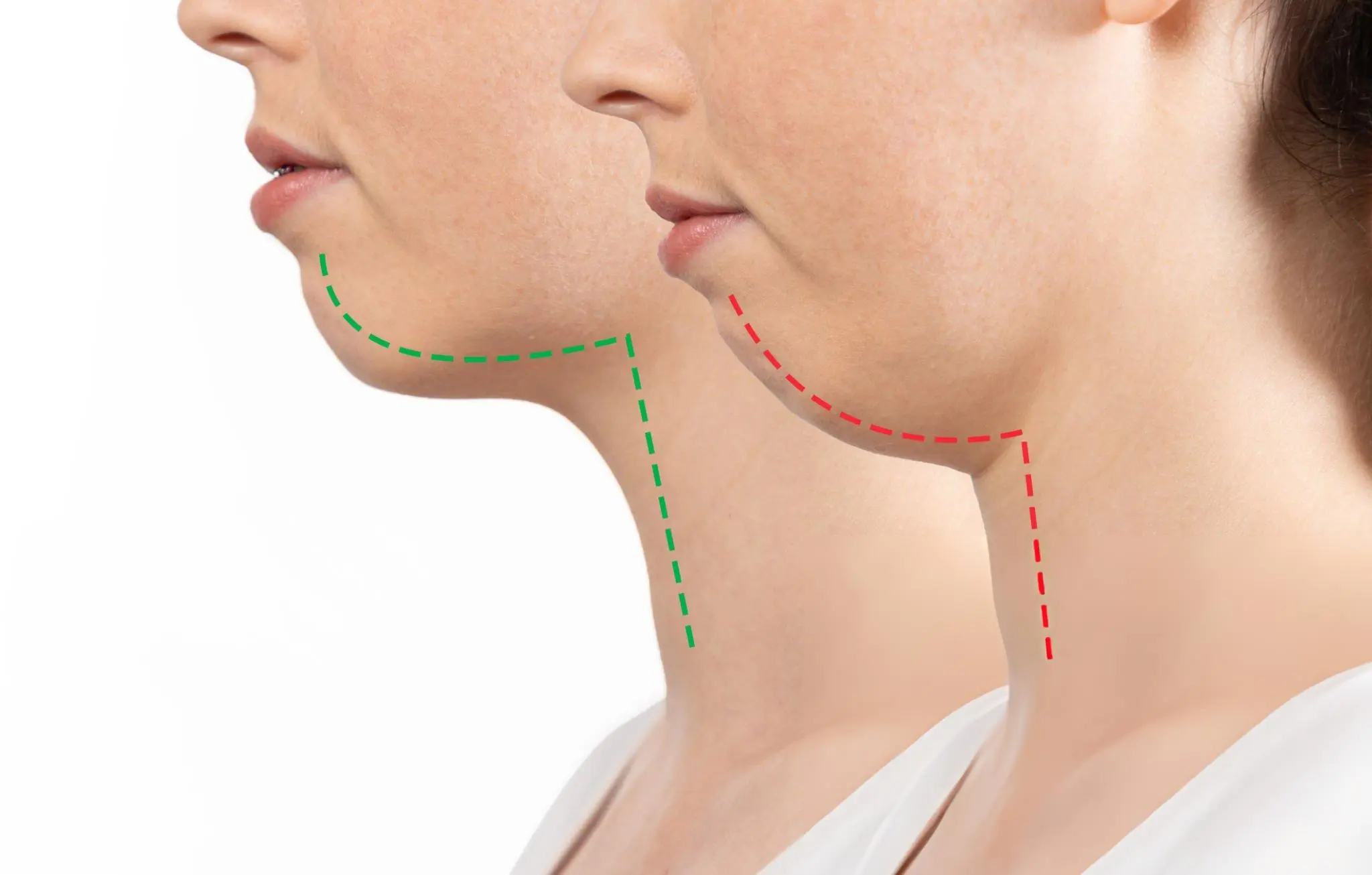 Sagging Jawline & Jowls Sagging Jawline & Jowls treatment in newcastle