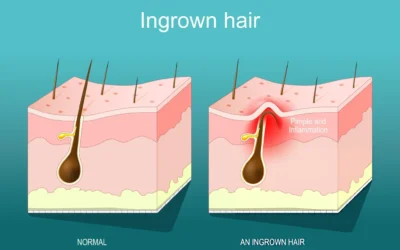 How Do You Get Rid of Ingrown Hairs?