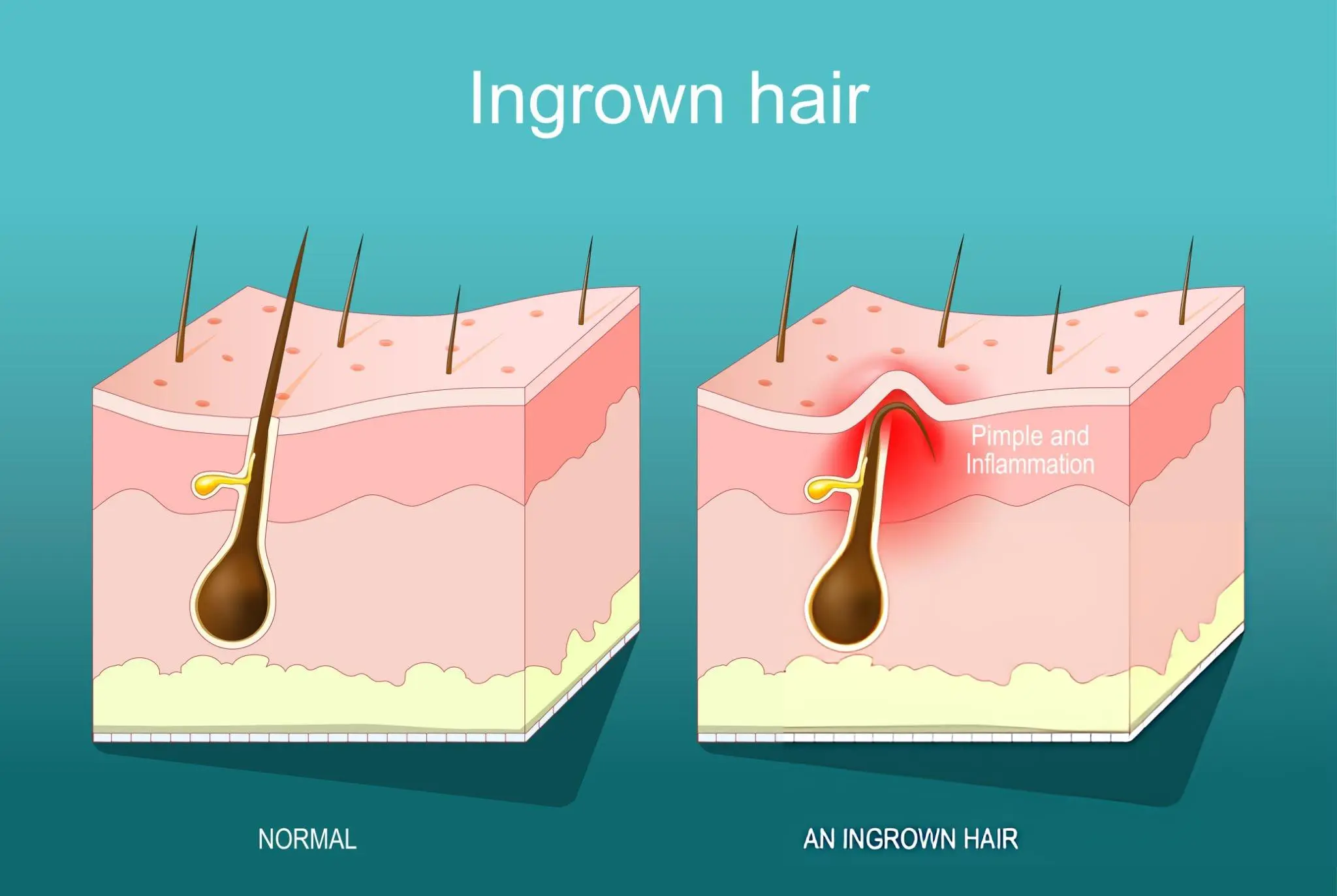 ingrown hair