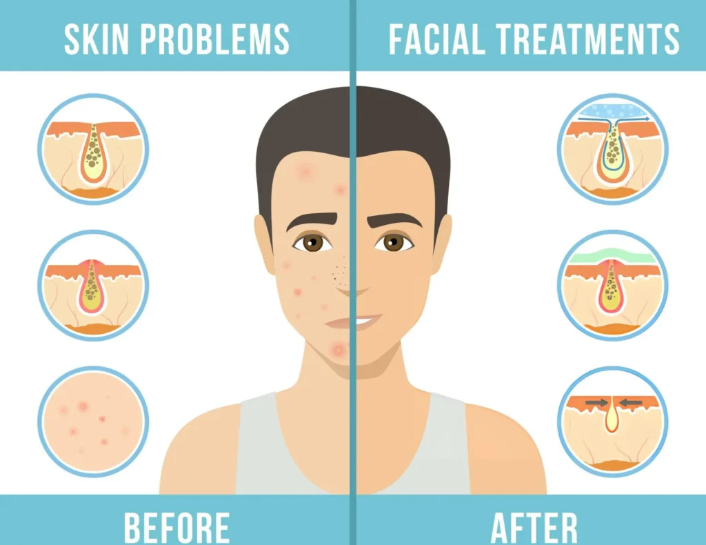 Acne scar treatment Acne scar treatment