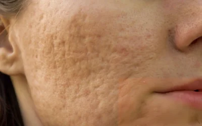 How to Get Rid of Acne Scars