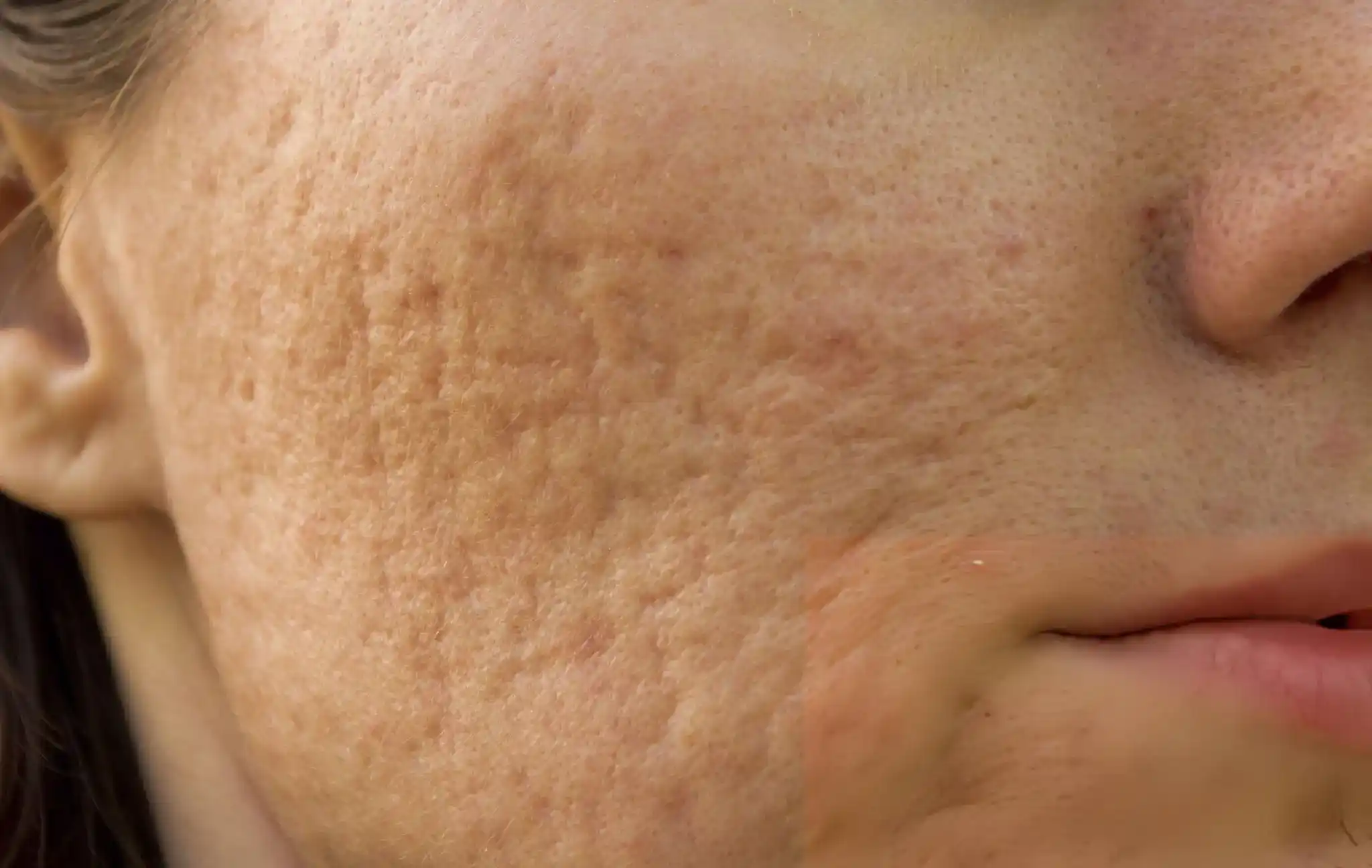 how to get rid of acne scars how to get rid of acne scars